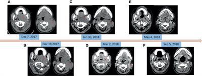 Case Report: Long-Term Response to Radiotherapy Combined With Targeted Therapy in Histiocytic Sarcoma Harboring Mutations in MAPK and PI3K/AKT Pathways